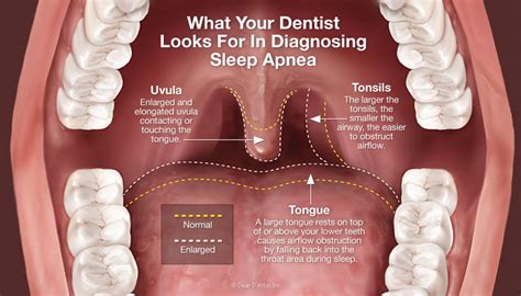 The dangers of sleep apnea - Dr Chauvin