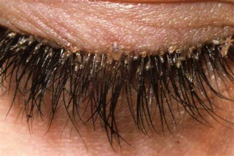 Eyelash(Demodex) Mites-Pictures on Dogs, Human Scalp, Face & How to get ...