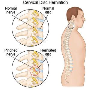 Cervical Disc Herniation (Discharge Care)