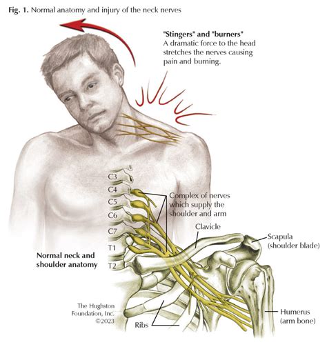 Brachial Plexus: Traumatic Nerve Injuries - Hughston Clinic