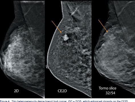 Figure 4 from The Principles of Contrast Mammography | Semantic Scholar