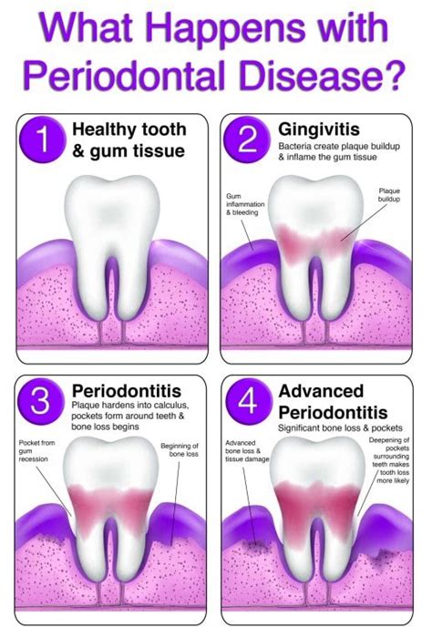 Periodontal disease (Gum Disease): Symptoms, Causes & Treatment ...