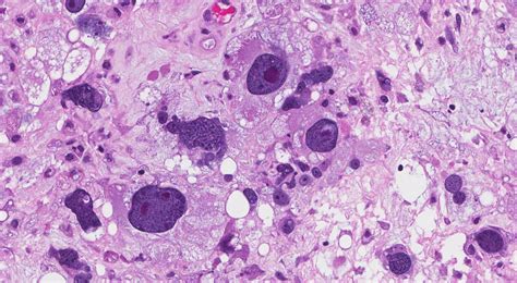 Pleomorphic | MyPathologyReport.ca