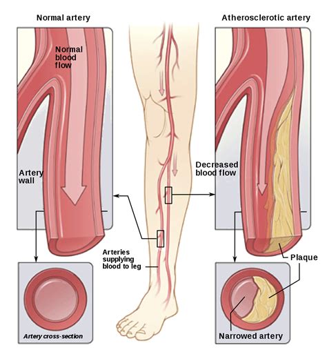 Peripheral Vascular Disease - Virginia Cardiovascular ...