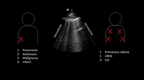 CHF Exacerbation (B-lines) lung ultrasound | POCUS | teachIM