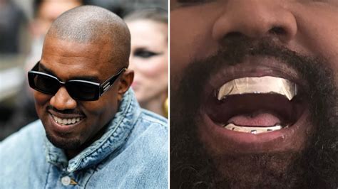 Kanye West spends $850,000 on permanent titanium teeth in drastic ...