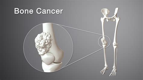 Bone Cancer: Types, Symptoms, Causes and Treatment - Scientific Animations