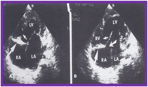 Echocardiography in the Diagnosis and Management of Tricuspid Atresia