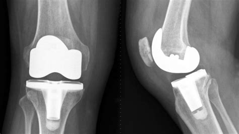 Exactech Optetrak and Truliant Knee Replacement Recalls