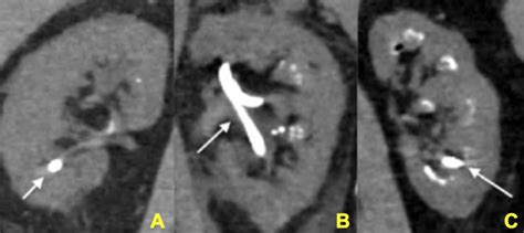 The Diagnostic Dilemma of Medullary Sponge Kidney | Kidney Stone ...