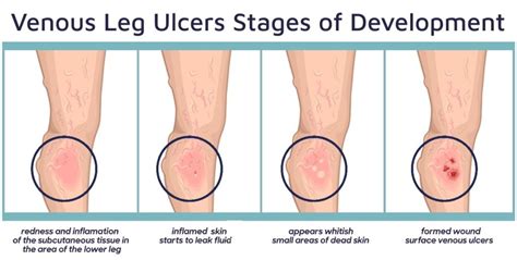 Why Not to Ignore a Leg Ulcer That Won’t Heal - Precision Vascular