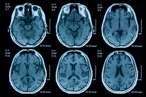 Brain MRI and EEG Clues to COVID-19-Related Encephalopathy ...