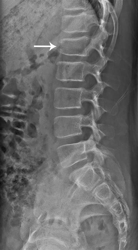 Anterior Vertebral Body Fracture