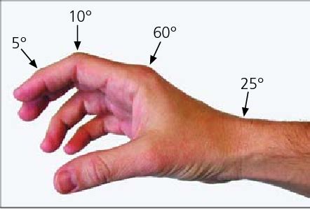 Figure 1 from Common acute hand infections. | Semantic Scholar