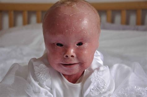 Harlequin ichthyosis causes, symptoms, diagnosis, survival & treatment