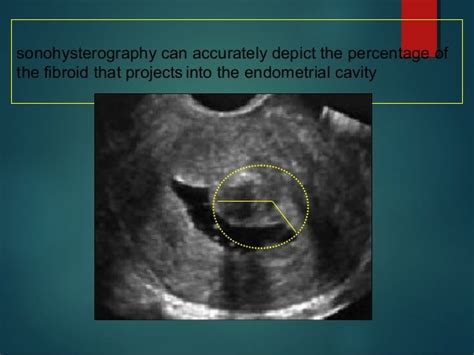 Sonohysterography