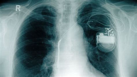 Medtronic Spinal Cord Stimulation MRI Guidelines