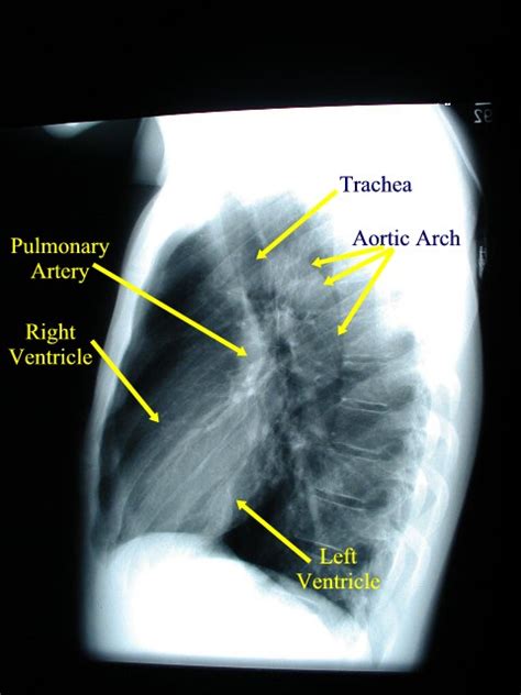 Normal Lateral Chest X Ray Male