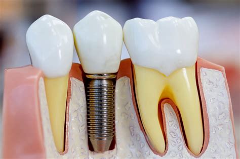 Dental Implant Procedure Steps | Adam Fienman, DDS | West Bloomfield