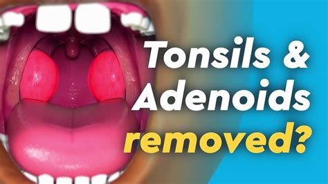 Tonsils and Adenoids Surgery - YouTube