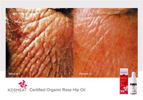 Rosehip Oil Before and Afters - Our Natural Skin Care Products | Kosmea