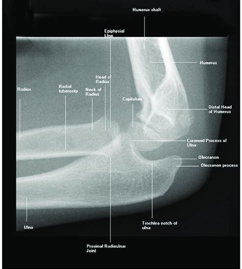 Normal Elbow X Ray In Children