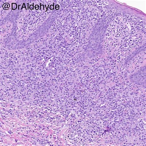 Mycosis Fungoides Prognosis