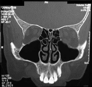 Sinus Treatment Tampa | Low Radiation Sinus CT Scanner | Florida ENT ...