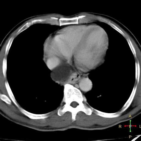 Oesophageal duplication cyst | Radiology Case | Radiopaedia.org ...