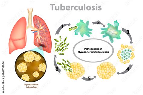 Tuberculosis (TB). Progression of pulmonary tuberculosis ...