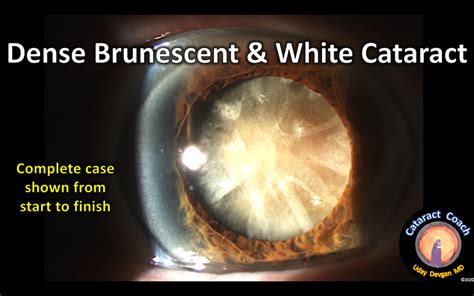 Complete Case: Brunescent & White Cataract – Cataract Coach™