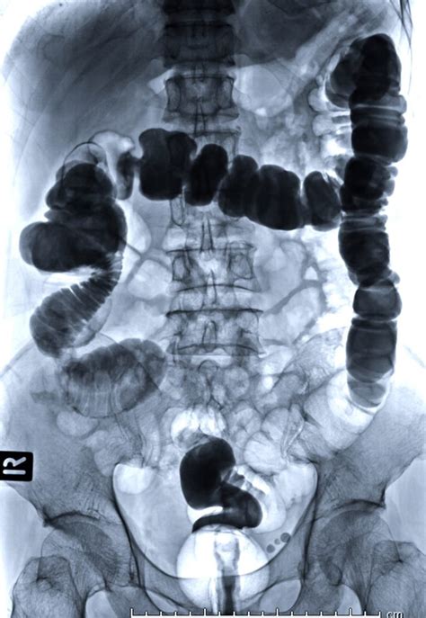 Computed Tomography of the Abdomen/Pelvis| Radiology Associates of ...