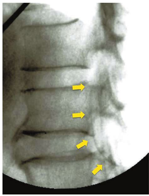 A: An X-ray image taken during the second operation of lumboperitoneal ...