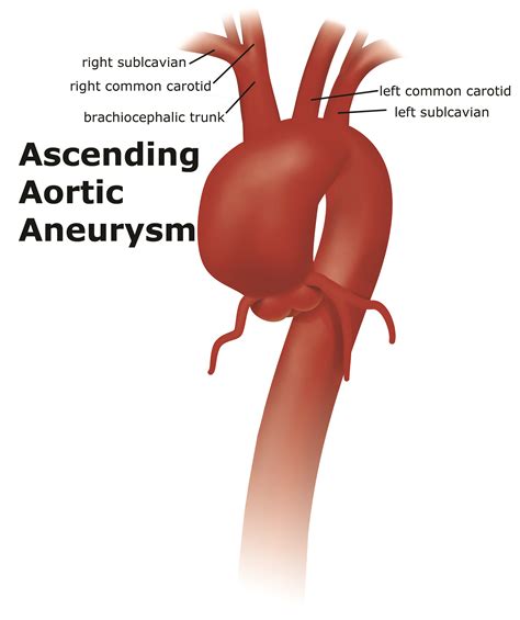 Thoracic Aortic Aneurysm | UF Health Aortic Disease Center|Diseases ...