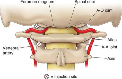 Atlanto-Axial Joint Injections | Anesthesia Key