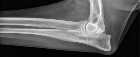 How To Treat Elbow Dysplasia In Dogs