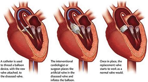 Transcatheter Aortic Valve Replacement (TAVR) - Center for Advanced ...