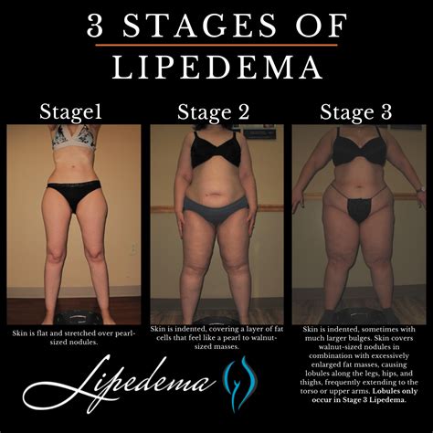 lipedema stages Archives - Lipedema