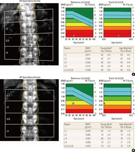 Bone mineral densitys of 2 cases show markedly reduced bone density of ...