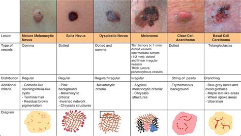 Types Skin Lesion Chart