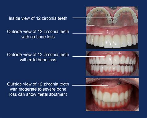 Bionic Smile Full Arch Implants