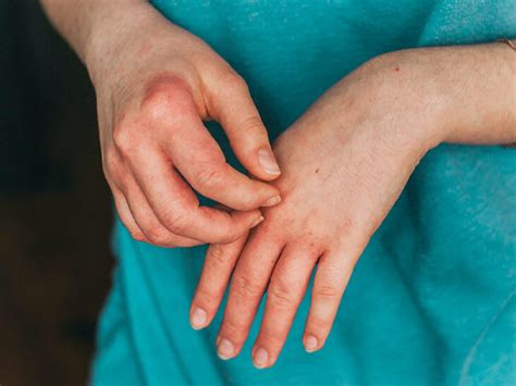 Eczema Itch & Exercise - Atopic Dermatitis | LearnSkin