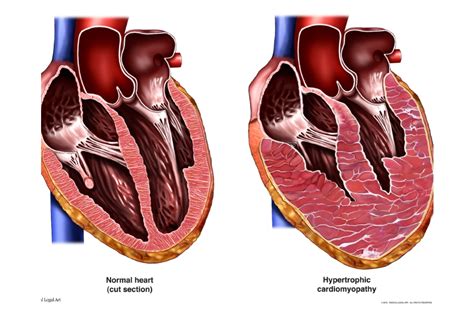 Cardiomyopathy - Types | NHLBI, NIH