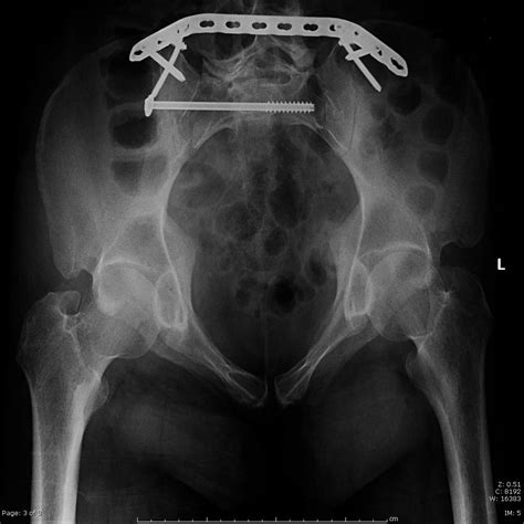 Sacral Fractures - Trauma - Orthobullets