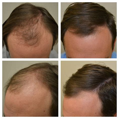 Minoxidil Before and After Photos [2024] | Is it right for you?