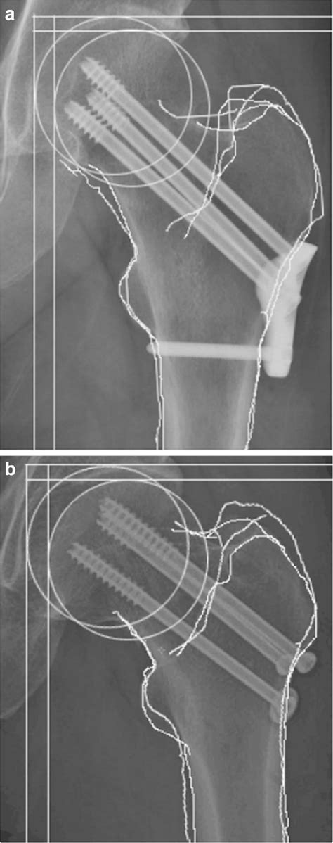 Femoral neck shortening was assessed in the horizontal and vertical ...