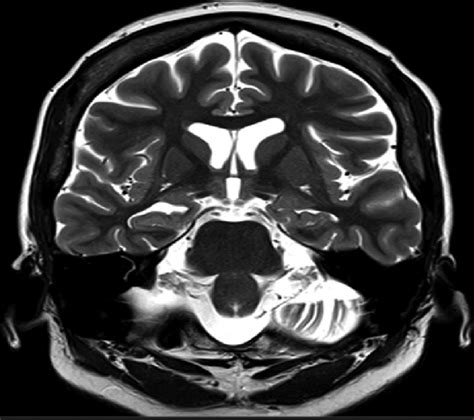 T-2 weighted MRI showing right hippocampal volume loss and a mild ...