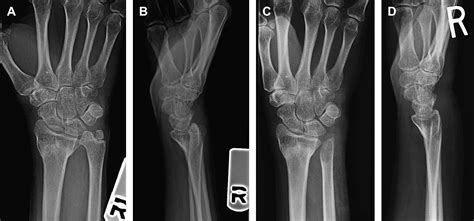 Complications of Distal Radius Fractures - Orthopedic Clinics