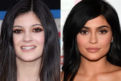 Kylie Jenner plastic surgery: Truth behind transformation revealed | OK ...