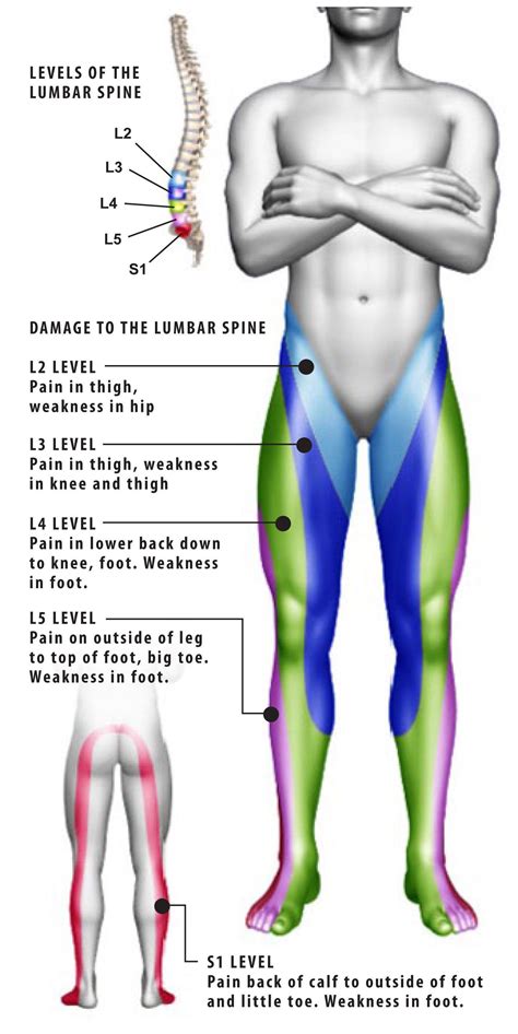 Lumbar Radiculopathy (Sciatica) - Plano, TX: Advanced Spine Center